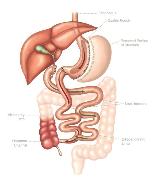 SADI-S Procedure Illustration